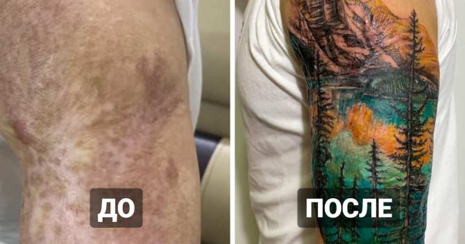 20 tatouages sur des cicatrices et des brûlures qui ont aidé des personnes à transformer leurs défauts en points forts.