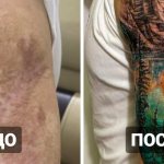 20 tatouages sur des cicatrices et des brûlures qui ont aidé des personnes à transformer leurs défauts en points forts.