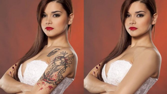 Jeune femme avec un tatouage effacé sur le bras