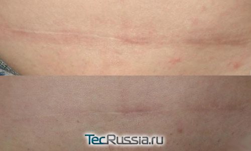 Avant et après l'utilisation de la pommade Contraktubec sur la cicatrice de césarienne