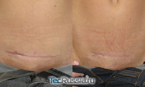Avant et après la correction au laser d'une cicatrice horizontale au niveau du ventre
