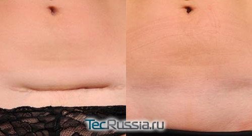 traitement chirurgical de la cicatrice abdominale