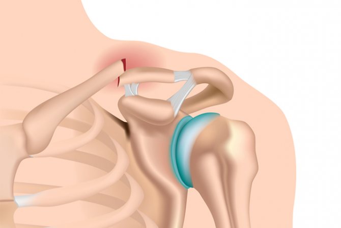Chirurgie pour une fracture