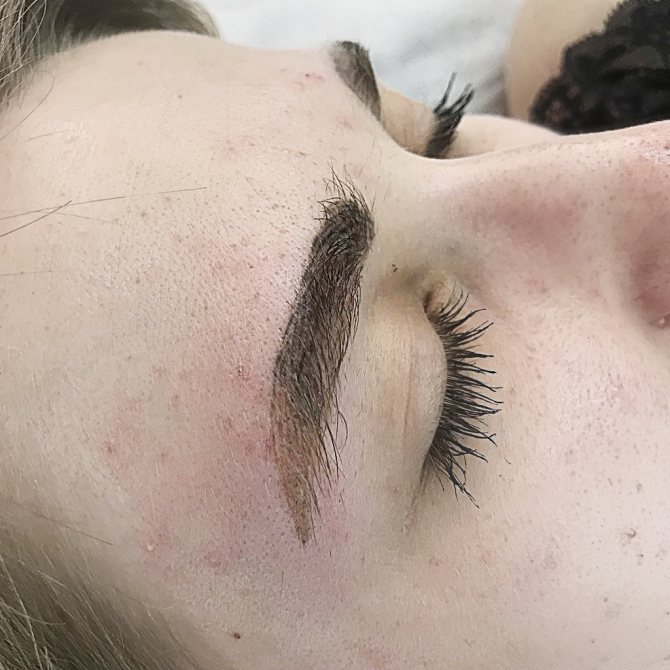 Inversion pigmentaire. Epilation au laser des sourcils.