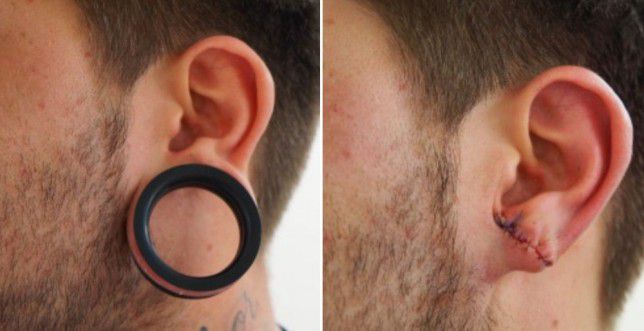 Comment faire des tunnels dans les oreilles complications de soins