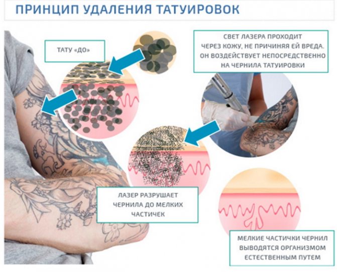 Comment se débarrasser d'un tatouage, enlever un tatouage à la maison