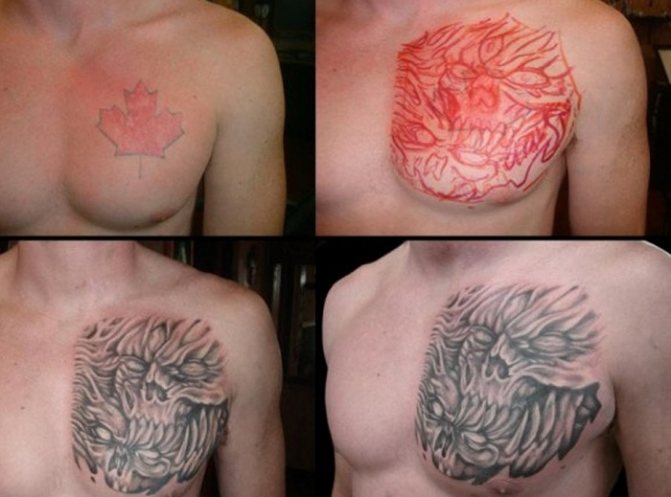 Comment enlever un tatouage sans laisser de cicatrice
