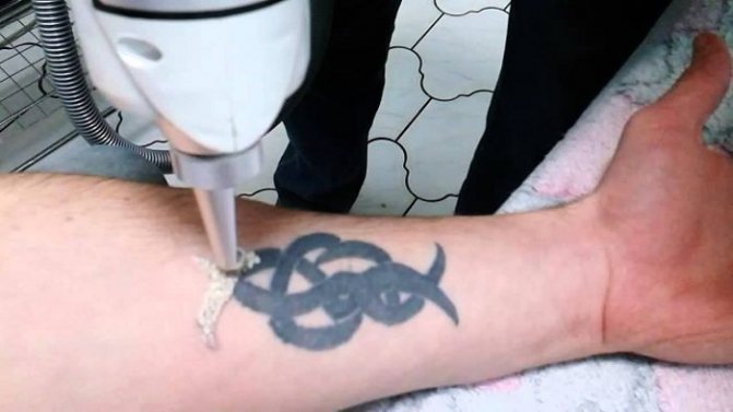 Comment enlever un tatouage sans laisser de cicatrice