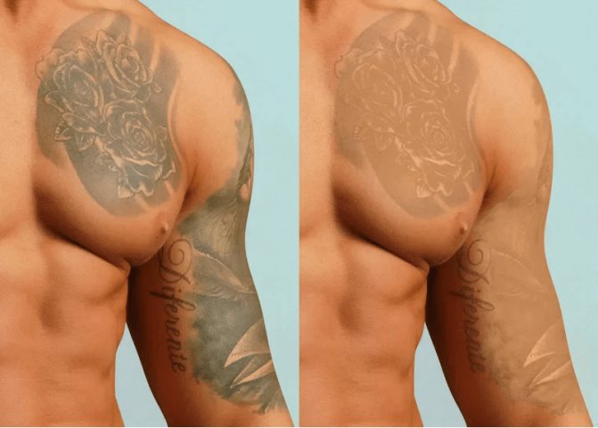 Quel tatouage est le plus facile à enlever ?