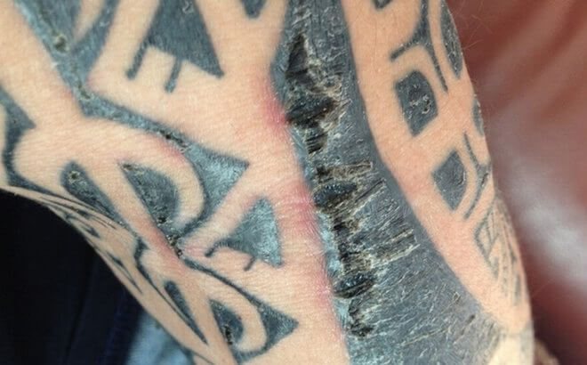 Croûte de tatouage