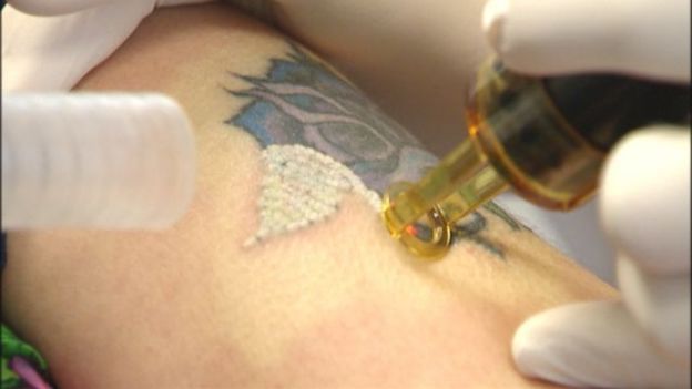 correction des tatouages au laser
