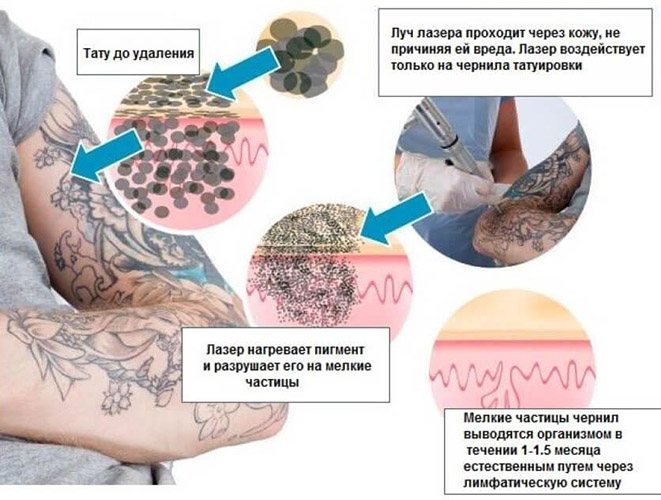 Le détatouage au laser. Critiques, photos avant et après