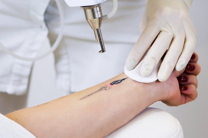 Enlèvement des tatouages au laser. Critiques, photos avant et après