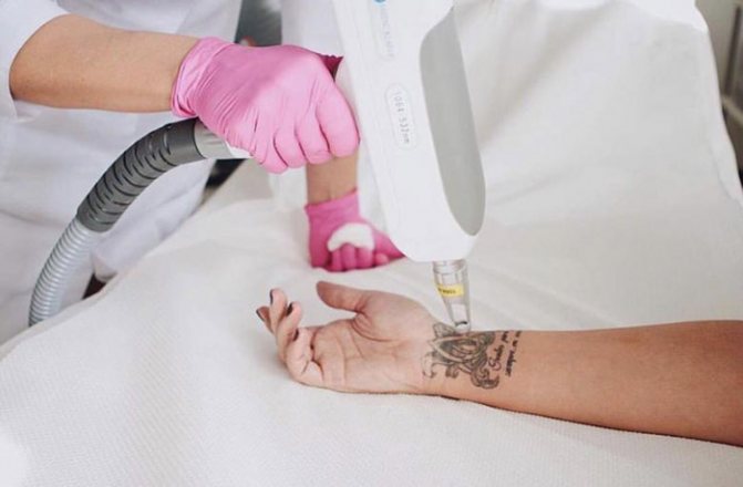 Le détatouage au laser. Critiques, photos avant et après