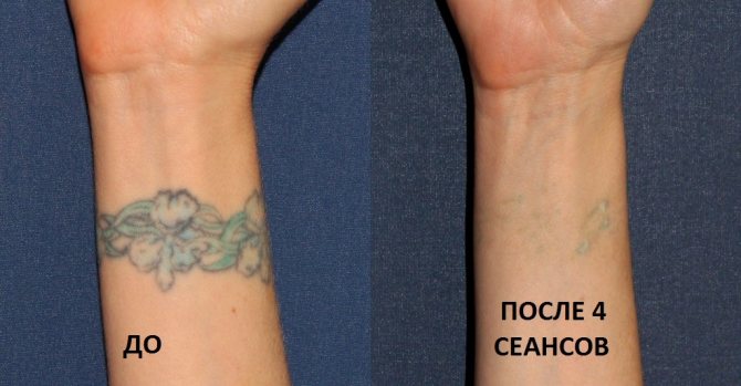 Enlèvement des tatouages au laser