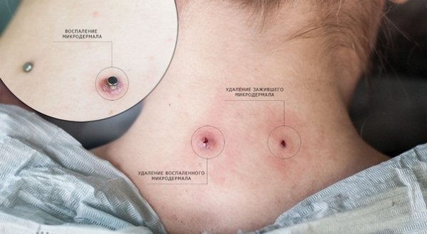 Microdermique sur le cou, le visage, le bras, la poitrine, la clavicule, le bas du dos. Qu'est-ce que c'est, une photo du piercing. Comment faire et réparer