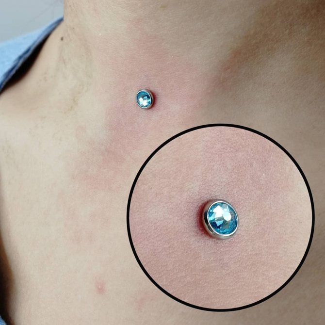 microdermique