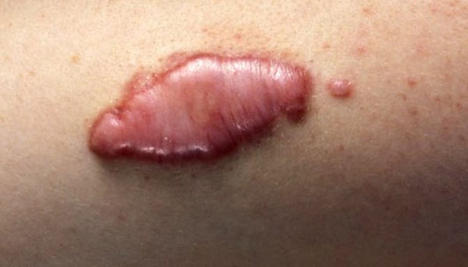 Puis-je me faire tatouer sur mes cicatrices ? Quels sont les tatouages qui peuvent être recouverts ? Répondre à ces questions