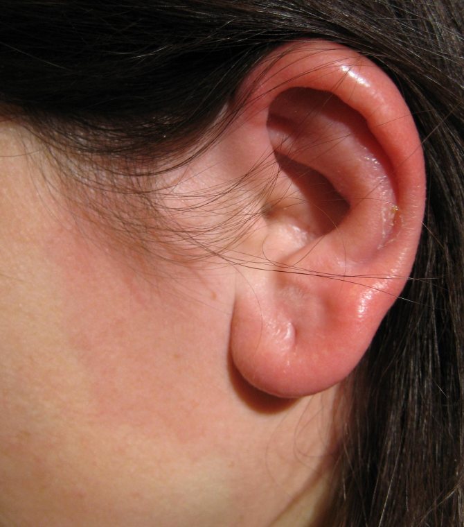 Gelure de l'oreille