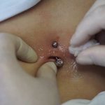 Traitement des perforations
