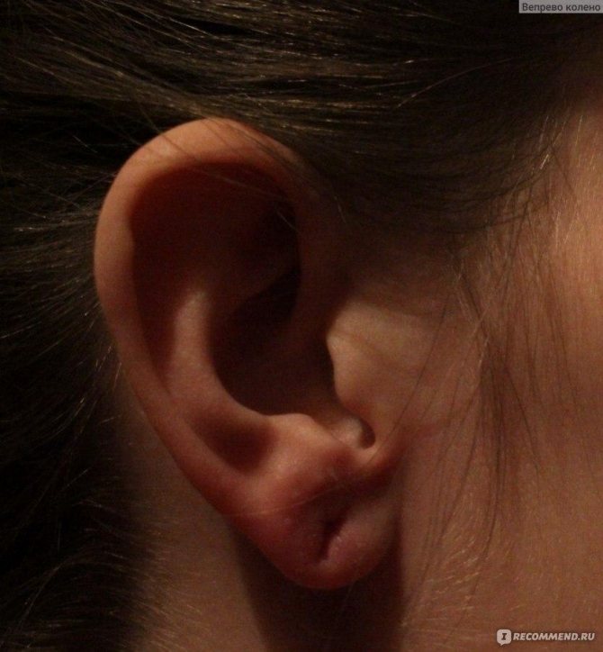 Œdème après le piercing