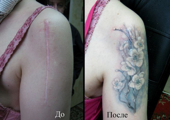 Recouvrement de la cicatrice par un tatouage au salon