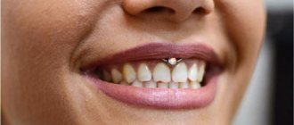 Piercing sous la lèvre supérieure (smiley) sur le frenulum. Photos, conséquences, critiques