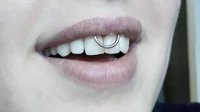 Piercing sous la lèvre supérieure (sourire) sur le frénulum. Photos, conséquences, critiques