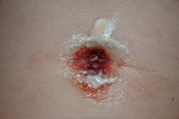Suivi des piercings corporels