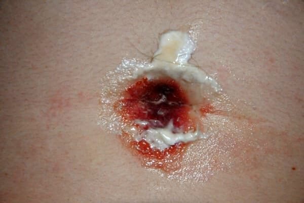Conséquences d'un échec du piercing du nombril