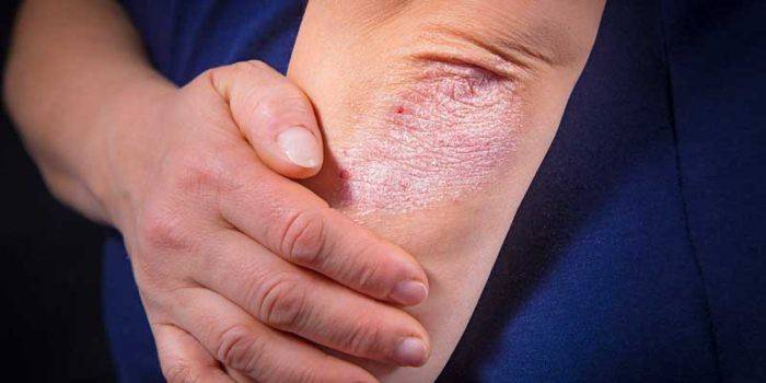 Psoriasis sur le coude d'une femme
