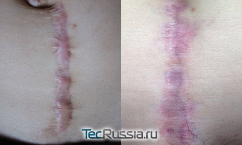 Résultats du resurfaçage au laser d'une cicatrice verticale après une césarienne