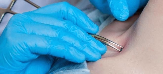Perçage du septum - technique de perçage, choix des bagues, boucles d'oreilles et autres bijoux, photos amusantes de notre travail