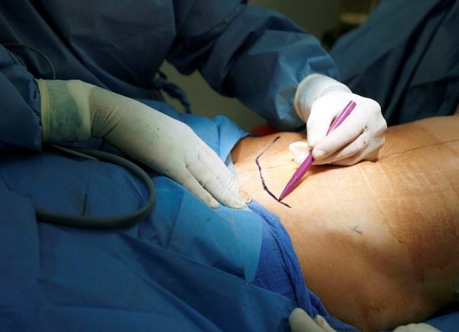 points de suture.jpg