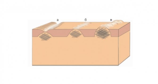 points de suture1.jpg