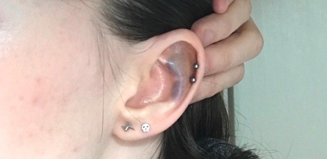 Contusion après un piercing