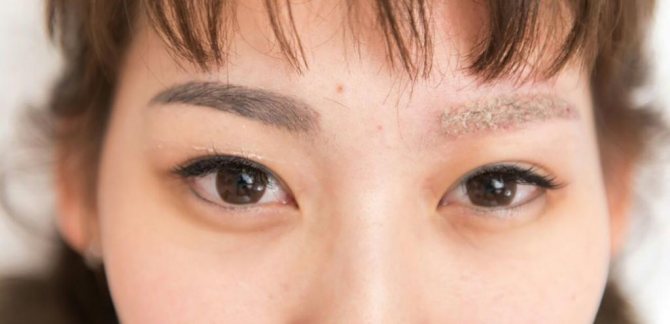 Combien de traitements faut-il pour effacer des tatouages ?