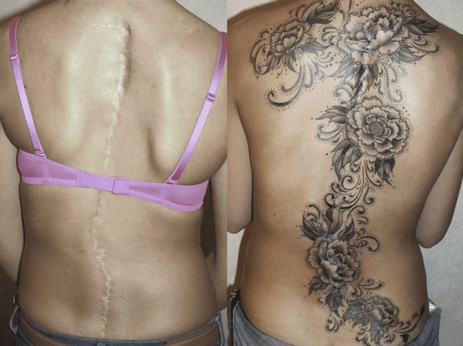 Conseils : Tatouage sur les cicatrices