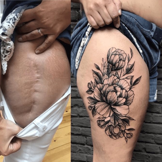 Conseils : Conseils : Tatouage sur les cicatrices