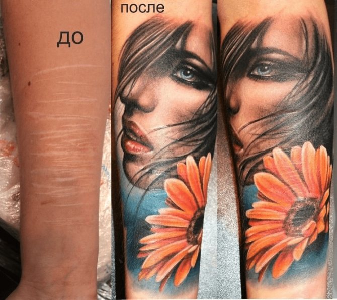 Conseils : Tatouages sur les cicatrices