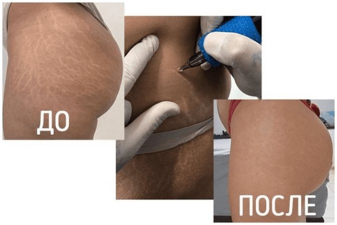 Conseils : Tatouages sur les cicatrices