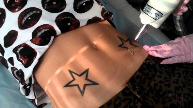 La technologie laser moderne permet de réaliser des tatouages, mais pas tous.