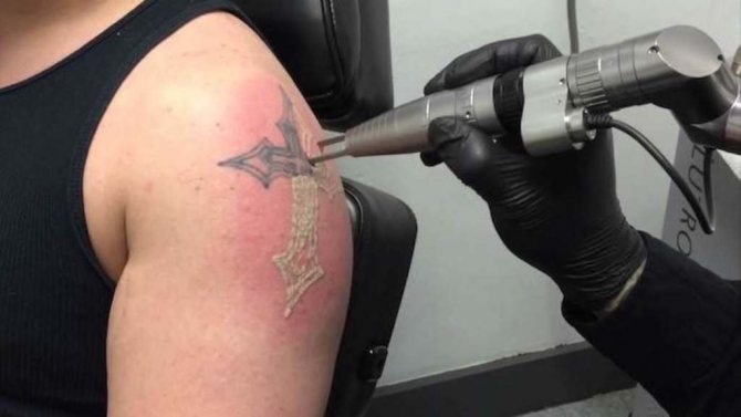 la suppression des tatouages