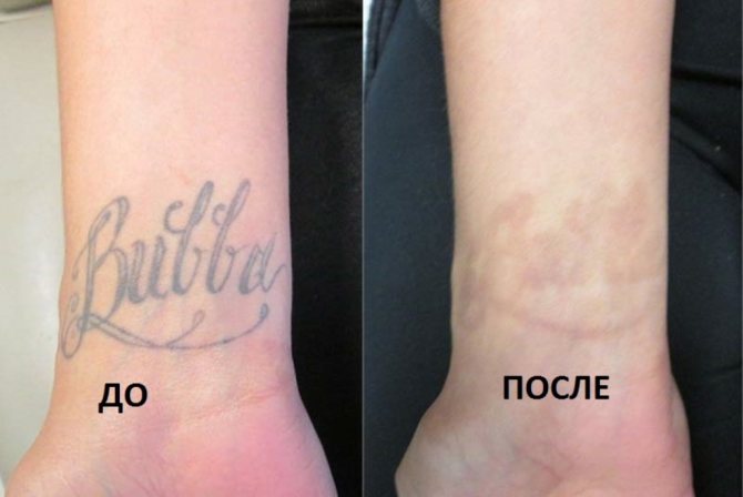 la suppression des tatouages
