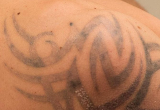 Enlèvement des tatouages au laser
