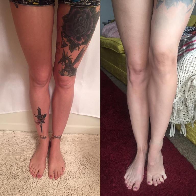 réduire le tatouage