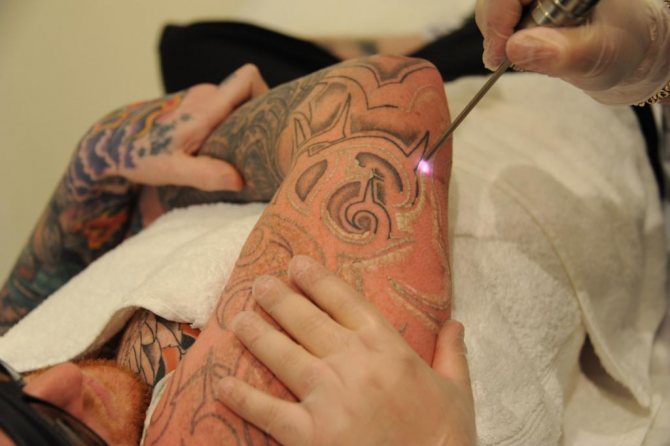 Enlèvement des tatouages au laser avant et après