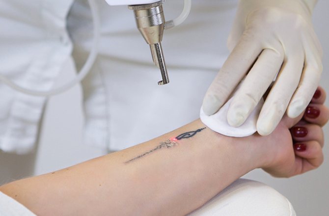 Curriculum vitae d'un tatoueur laser