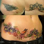 Tatouage pour cacher les points de suture après une césarienne