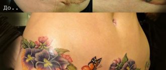 Tatouage pour cacher les points de suture d'une césarienne sur le ventre